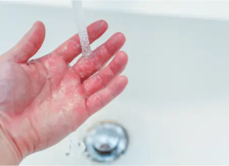 hard water affecting skin